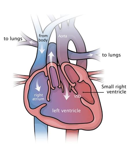 double inlet lv|double inlet left ventricle prognosis.